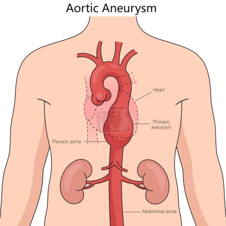 Aortenaneurysma-Strukturdiagramm, handgezeichnete schematische Vektorillustration. Pädagogische Illustration der Medizinwissenschaften