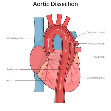 Human aortic dissection, showing the true and false lumens and a tear in the aortic wall structure diagram hand drawn schematic vector illustration. Medical science educational illustration