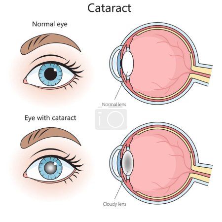 normal eye and one with a cataract, showing clear and cloudy lenses respectively structure diagram hand drawn schematic vector illustration. Medical science educational illustration