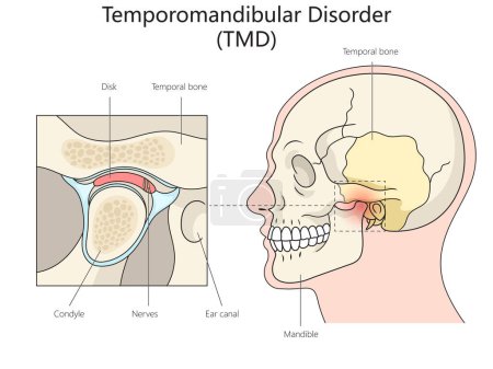 Human Temporomandibular disorder diagram hand drawn schematic vector illustration. Medical science educational illustration