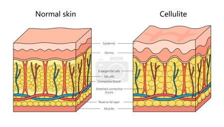 Diagrama de estructura de piel de celulitis humana ilustración vectorial esquemática dibujada a mano. Ilustración educativa de ciencias médicas