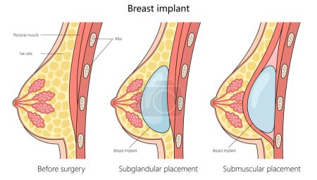 comparaison de l'anatomie mammaire avant l'intervention chirurgicale et avec l'illustration vectorielle dessinée à la main des placements d'implants mammaires sous-glandulaires et sous-musculaires. Illustration pédagogique en sciences médicales