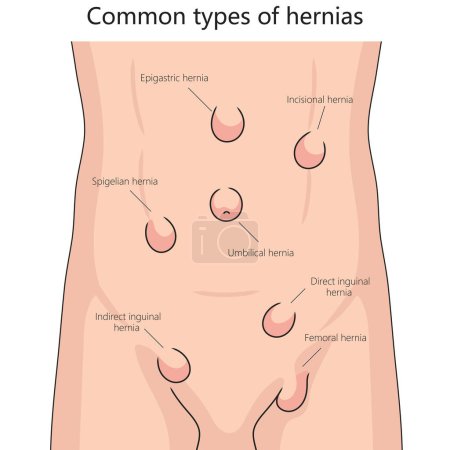 Human various hernia types on human abdomen for health and medical studies structure diagram hand drawn schematic vector illustration. Medical science educational illustration