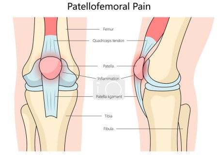 Patellofemoral pain syndrome structure diagram hand drawn schematic vector illustration. Medical science educational illustration