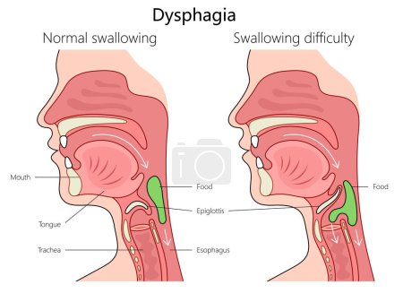 dysphagia swallowing difficulty and normal swallowing with labeled anatomy structure vertebral column diagram hand drawn schematic vector illustration. Medical science educational illustration