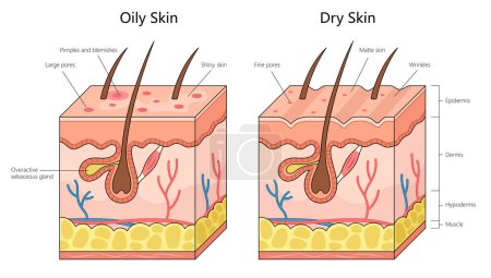 Human oily skin with dry skin, differences in sebaceous gland activity, pore size, and skin texture structure diagram hand drawn schematic vector illustration. Medical science educational illustration