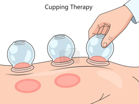 Photo for Cupping therapy on skin, showcasing suction technique and resulting skin reaction diagram hand drawn schematic vector illustration. Medical science educational illustration - Royalty Free Image