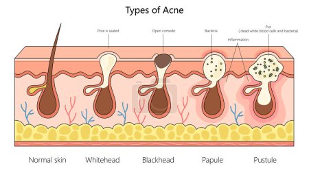 varios tipos de acné, desde la piel normal hasta pústulas inflamadas, para estudios dermatológicos diagrama de estructura ilustración de vectores esquemáticos dibujados a mano. Ilustración educativa de ciencias médicas