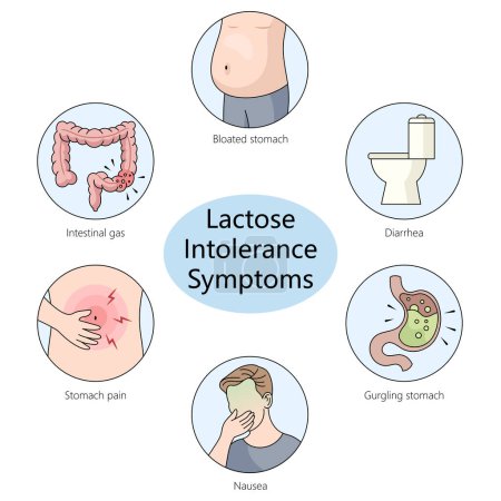  Diagramm mit typischen Symptomen im Zusammenhang mit Laktose-Intoleranz, wie Blähungen und Durchfall, von Hand gezeichnete schematische Vektorillustration. Pädagogische Illustration der Medizinwissenschaften