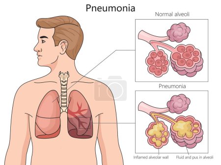 normal alveoli and pneumonia-affected alveoli, highlighting inflamed walls and fluid buildup structure diagram hand drawn schematic vector illustration. Medical science educational illustration