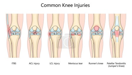 various common knee injuries, LCL injury, meniscus tear, runners knee, and patellar tendonitis structure diagram hand drawn schematic vector illustration. Medical science educational illustration