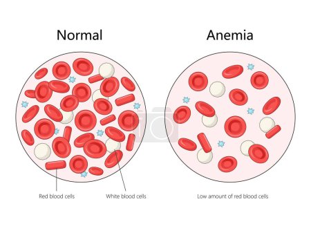 normale Blutzellen mit anämischen Blutzellen, wobei die geringe Menge an roten Blutzellen im Anämiediagramm hervorgehoben wird, das eine schematische Vektorillustration darstellt. Pädagogische Illustration der Medizinwissenschaften