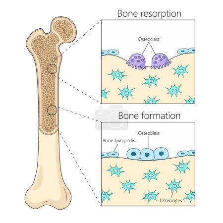 Knochenresorptions- und -bildungsprozesse, wobei die Aktivität von Osteoklasten und Osteoblasten im Knochengewebediagramm hervorgehoben wird. Pädagogische Illustration der Medizinwissenschaften
