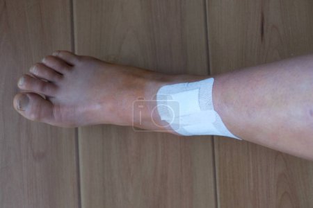 Photo for Injured broken leg wit bruises after operation - Royalty Free Image