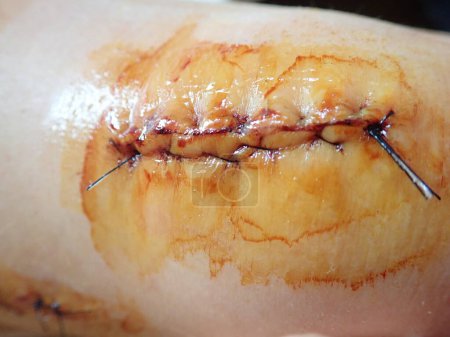 détail des points de suture sur une cicatrice sur un genou