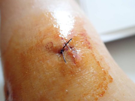Photo for Detail of stitches on a scar on a knee - Royalty Free Image