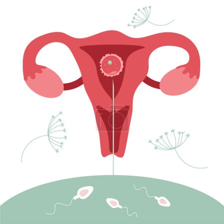 Illustration for The illustration with illustrarion with procedureinsemination Intrauterine, IUI. The planing pregnant Illustration with egg cell, sperm cell good for poster medical clinic. This is vector illustration was made in hand drawn art. - Royalty Free Image