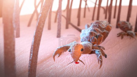 Photo for Head louse on a human head 3d render - Royalty Free Image