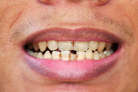 Imagen detallada de la boca de un hombre con dientes amarillos, desordenados y labios agrietados, labios negros. Atención de salud dental y bucal. Higiene dental. Odontología y boca