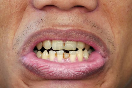 Imagen detallada de la boca de un hombre con dientes amarillos, desordenados y labios agrietados, labios negros. Atención de salud dental y bucal. Higiene dental. Odontología y boca