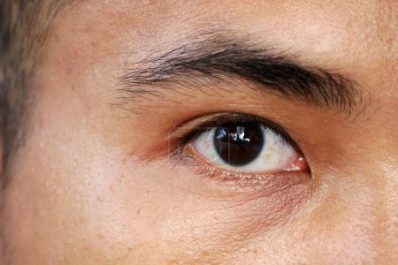 Man's eyes with inflamed and dilated red capillaries. Bleeding under the conjunctiva. Conjunctivitis, keratitis, dry eye syndrome, trauma, uveitis