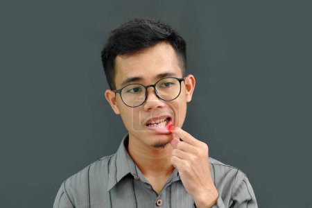 Asian man has aphthous boils on his lips.