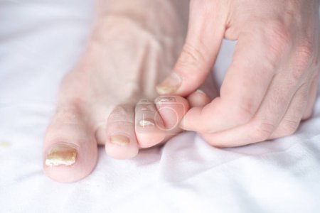 Photo for Male cut nails with nail fungus. Fungal infection on nails legs, finger with onychomycosis. Care and treatment. Closeup of a foot with damaged nails because of fungus - Royalty Free Image