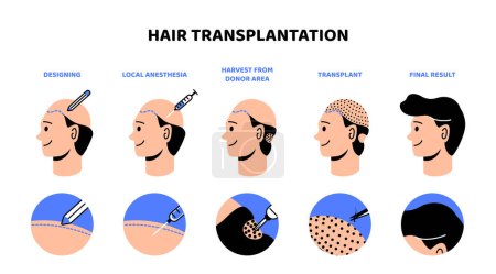 Hair transplantation process infographic. Medical beauty treatments. Fight against alopecia. Design, anesthesia, harvest from donor area and transplant. Cartoon flat vector illustration