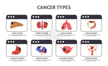 Illustration for Types of cancer concept. Medical infographics and educational materials. Internal organs, biology and anatomy. Poster or banner. Cartoon flat vector illustration isolated on white background - Royalty Free Image
