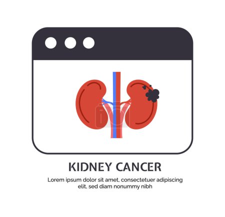 Illustration for Type of cancer kidney concept. Disease of iternal organ. Healthcare and medicine, treatment. Template, layout and mock up. Cartoon flat vector illustration isolated on white background - Royalty Free Image