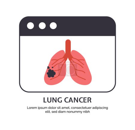 Illustration for Type of cancer lungs concept. Disease of iternal organ. Problems with respiratory system. Poster or banner for website. Cartoon flat vector illustration isolated on white background - Royalty Free Image