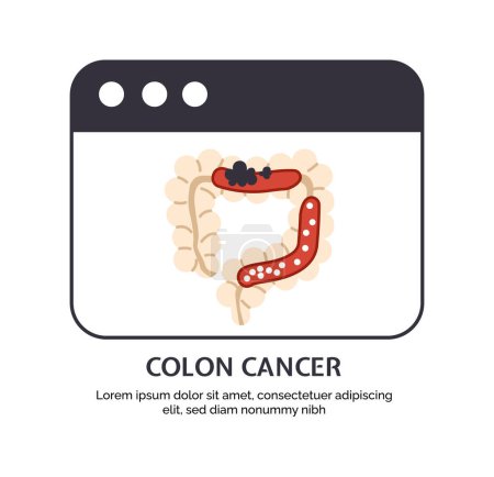 Illustration for Type of cancer colon concept. Disease of iternal organ. Illness of digestive system. Graphic element for website. Cartoon flat vector illustration isolated on white background - Royalty Free Image