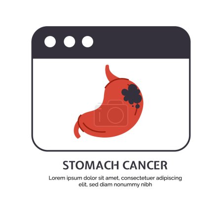 Illustration for Type of cancer stomach concept. Disease of iternal organ. Medical infographics and educational materials. Digestive system problem. Cartoon flat vector illustration isolated on white background - Royalty Free Image
