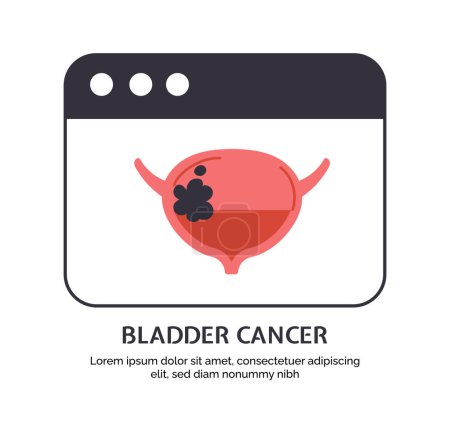 Illustration for Type of cancer bladder concept. Disease of iternal organ. Medical infographics, biology and anatomy. Template, layout and mock up. Cartoon flat vector illustration isolated on white background - Royalty Free Image