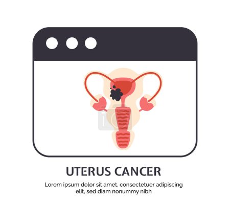Illustration for Type of cancer uterus concept. Disease of iternal organ. Illness of reproductive system. Graphic element for website. Cartoon flat vector illustration isolated on white background - Royalty Free Image