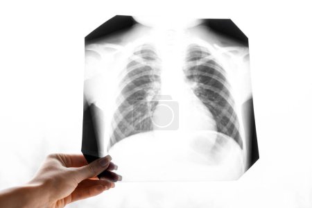 Eine Momentaufnahme der Lungen. Fluorographie. Gesunde Lungen. Röntgen der Brust in das Lumen auf einem weißen Bildschirm. Rippen und Lungen im Röntgenbild. Coronavirus. Ein Symbol für einen gesunden Lebensstil. Ökologie. Rein planetarisch. Lungen von Kindern.