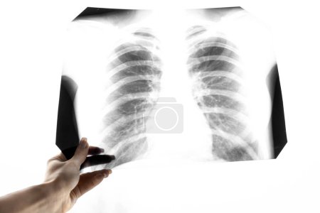 Eine Momentaufnahme der Lungen. Fluorographie. Gesunde Lungen. Röntgen der Brust in das Lumen auf einem weißen Bildschirm. Rippen und Lungen im Röntgenbild. Coronavirus. Ein Symbol für einen gesunden Lebensstil. Ökologie. Rein planetarisch. Nicht rauchen.