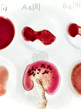 Foto de Reacción de aglutinación médica para determinar la compatibilidad del grupo sanguíneo. Foto de alta calidad - Imagen libre de derechos