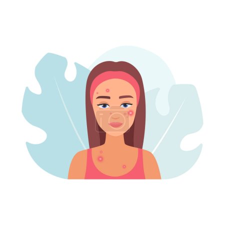 Illustration for Young woman with acne puberty problem and red pimples on face vector illustration - Royalty Free Image