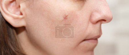 Echte Narbe im Gesicht der jungen Frau, Narbe auf der Wange nach einer Operation zur Entfernung des Maulwurfs. Narbe nach Schönheitsoperation