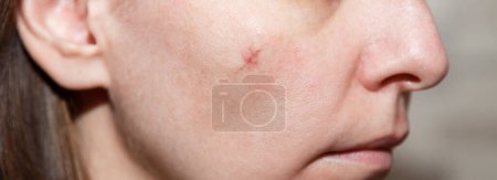 Echte Narbe im Gesicht der jungen Frau, Narbe auf der Wange nach einer Operation zur Entfernung des Maulwurfs. Narbe nach Schönheitsoperation