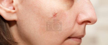 Real scar on the young woman face, scar on the cheek after a mole removal surgery. Scar after plastic surgery