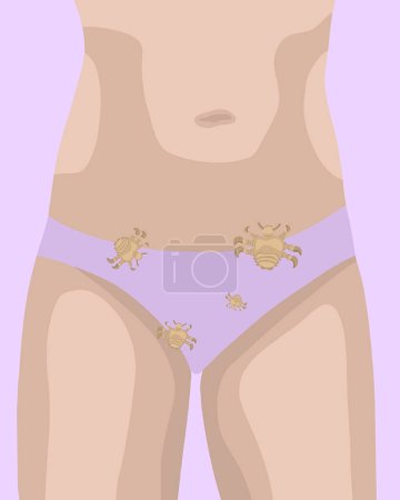 Téléchargez les illustrations : Illustration vectorielle isolée des poux du pubis femelles. Contact avec une personne atteinte de poux du pubis. - en licence libre de droit