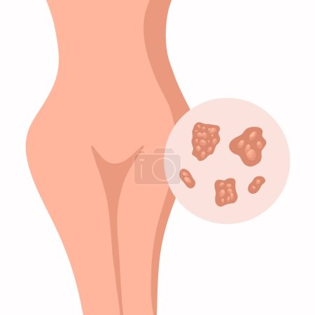 Illustration for Vector isolated illustration of genital herpes in women. Rash of genital herpes. - Royalty Free Image