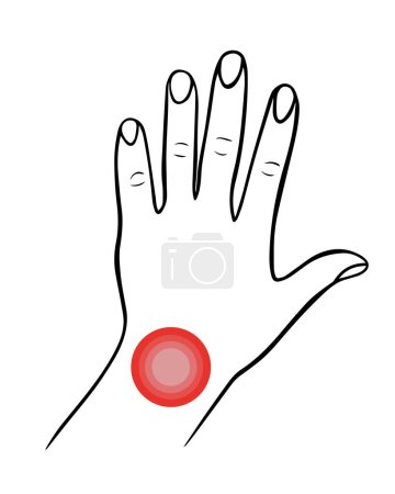 Illustration for Vector isolated illustration of wrist pain. Hand with localization of pain in the wrist. - Royalty Free Image