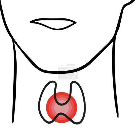 Téléchargez les illustrations : Illustration vectorielle isolée de la glande thyroïde. Élargissement de la glande thyroïde. - en licence libre de droit