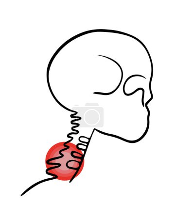 Téléchargez les illustrations : Illustration vectorielle isolée de douleurs vertébrales cervicales. Dessin contour de la région cervicale avec localisation de la douleur dans les vertèbres. - en licence libre de droit