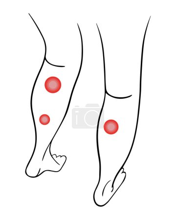 Illustration for Varicose veins of the legs. Treatment of varicose veins. - Royalty Free Image