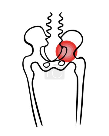 Illustration for Vector isolated illustration of pelvic bone injury. Pelvic fracture. Pain in the pelvic bone. - Royalty Free Image
