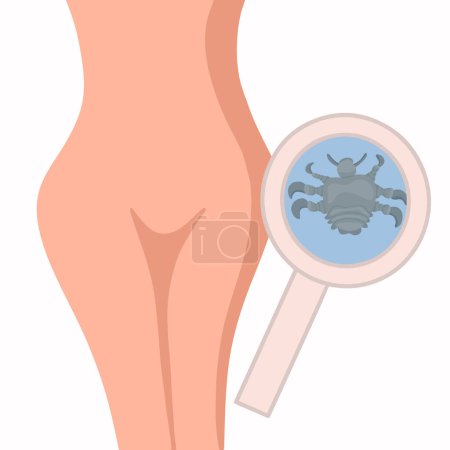 Vector isolated illustration of female pubic lice. Contact with a person with pubic lice.